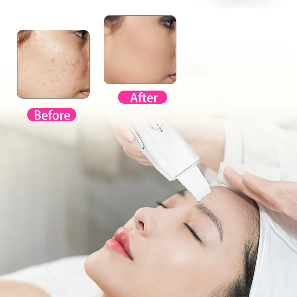 Beauty Star Ultrasonic Skin Scrubber Massager Machine Facial Skin Cleaning Anion Face Skin Care Ultrasound Peeling Skin Scrubber